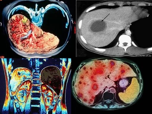 Расшифровка кт печени фото Саркома печени: симптомы и лечение