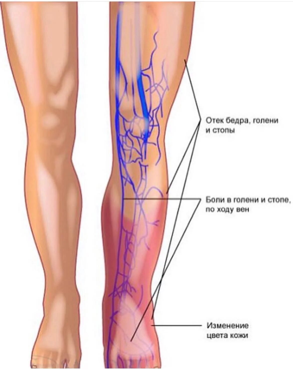 Расширение вен нижних конечностей фото Боль нижней трети бедра - найдено 86 картинок