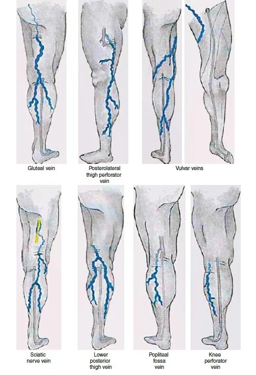 Расширение вен нижних конечностей фото Options for non-safe reflux in subcutaneous veins Source: Labropoulos N, Tiongso