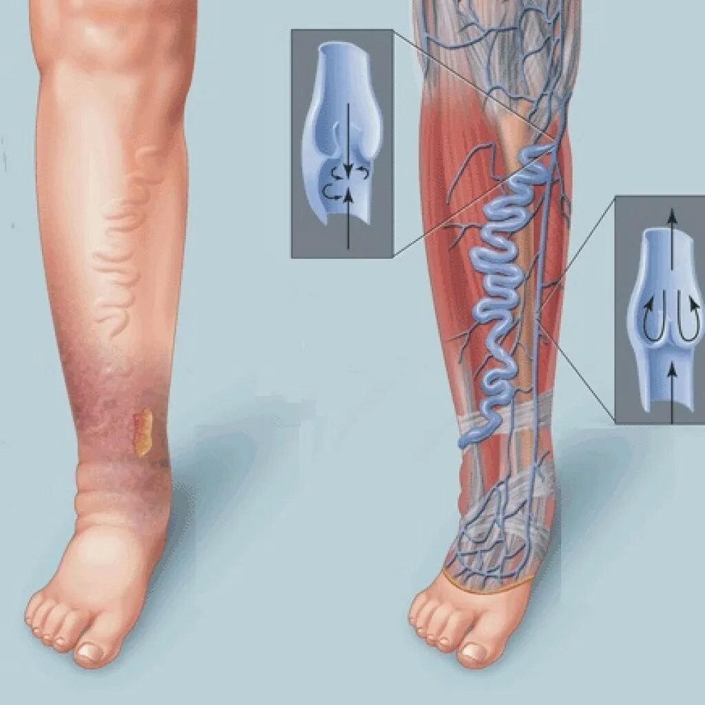 Расширение вен нижних конечностей фото Тромбофлебит: симптомы, причины, лечение Диагностика и уход за венами
