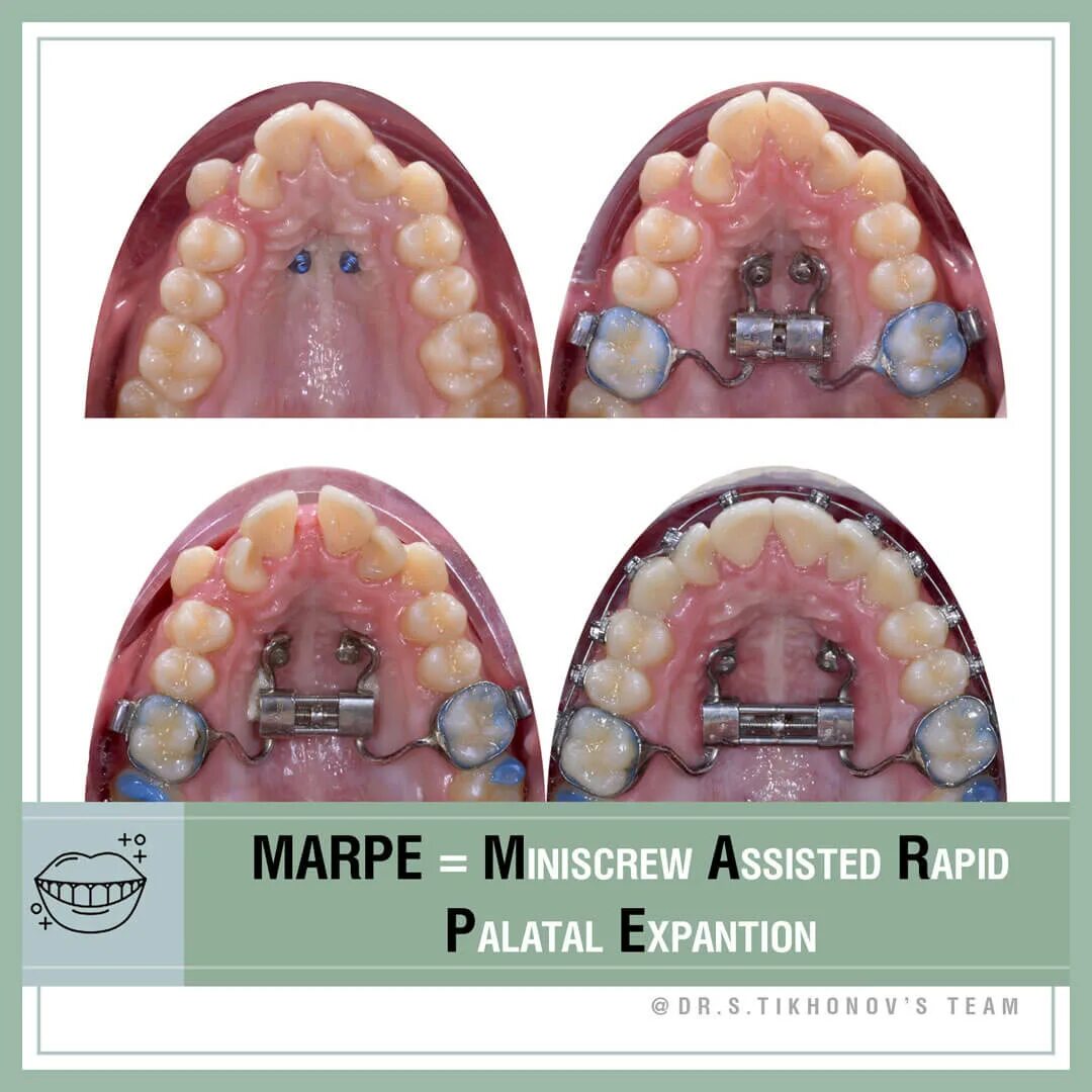 Расширение верхней челюсти фото MARPE = Miniscrew Assisted Rapid Palatal Expantion. - интересно об ортодонтии, и