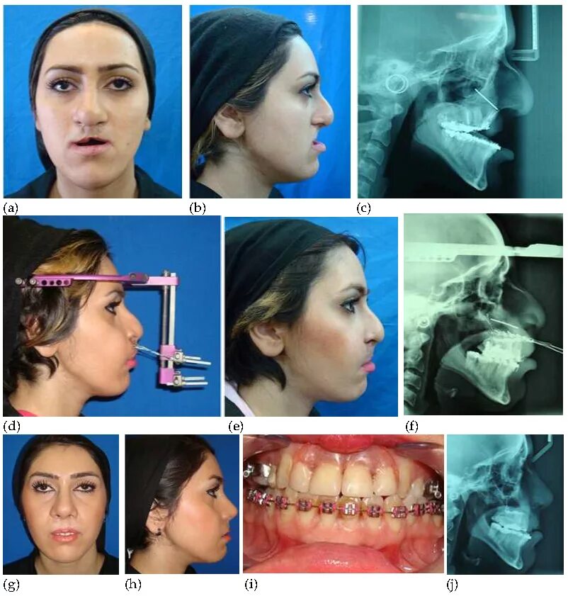 Расширение верхней челюсти фото Челюстно лицевая хирургия прикус - найдено 88 фото