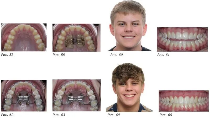Расширение верхней челюсти фото Некоторые способы временной опоры могут помочь быстрее завершить лечение пациент