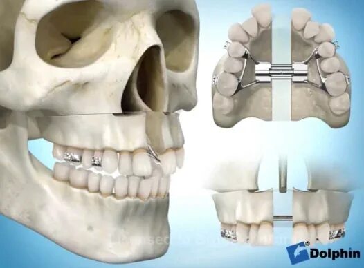 Расширение верхней челюсти фото disjonction intermaxillaire on Vimeo