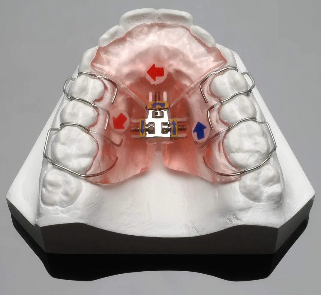 Расширяющий аппарат верхнюю челюсть фото 3-Wege-Gerät Für Palatale Expander/Kieferorthopädische Expansion - China palatal