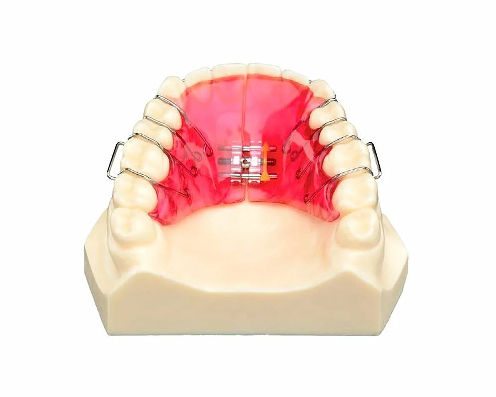 Figure 1 from Immediate effects of rapid maxillary expansion with Haas-type and 