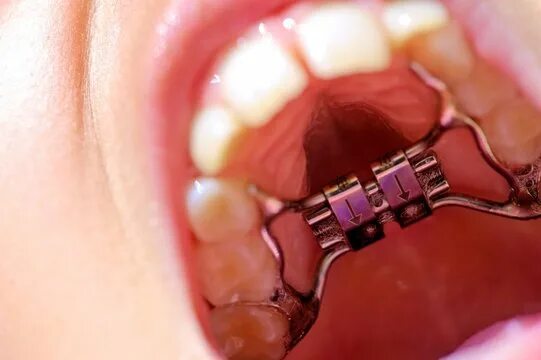 Расширяющий аппарат верхнюю челюсть фото Orthodontie Зображення - огляд 302 Стокові фото, векторні зображення й відео Ado