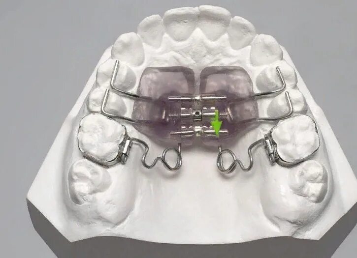 Расширяющий аппарат верхнюю челюсть фото Аппарат Хааса ортодонтия для детей и взрослых в Балашихе, стоимость пластинки Кл