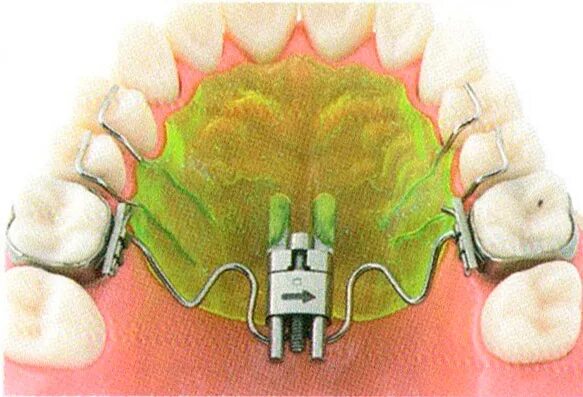 Расширяющий аппарат верхнюю челюсть фото Каппы-элайнеры для детей - установка в Нижнем Новгороде Цены