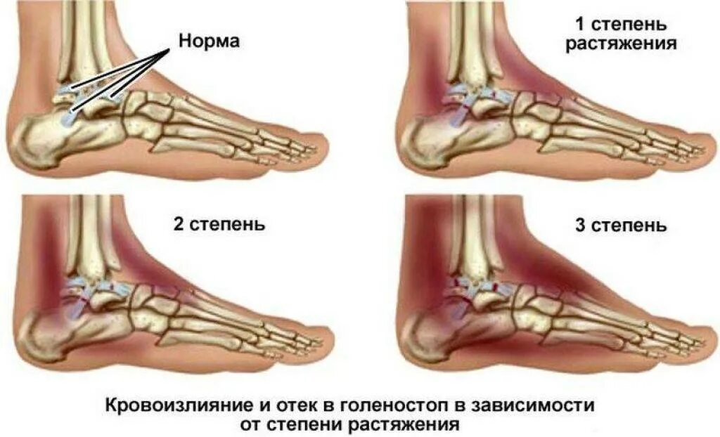 Растяжение голеностопа симптомы фото Внутреннее растяжение связок