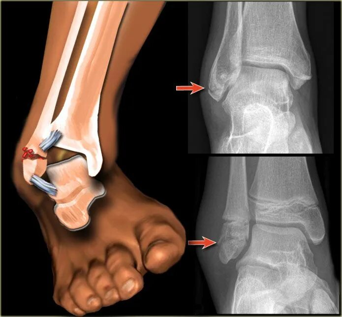 Растяжение голеностопа симптомы фото Ankle Sprain Injury Fractura de tobillo, Ligamentos del tobillo y Anatomía del t