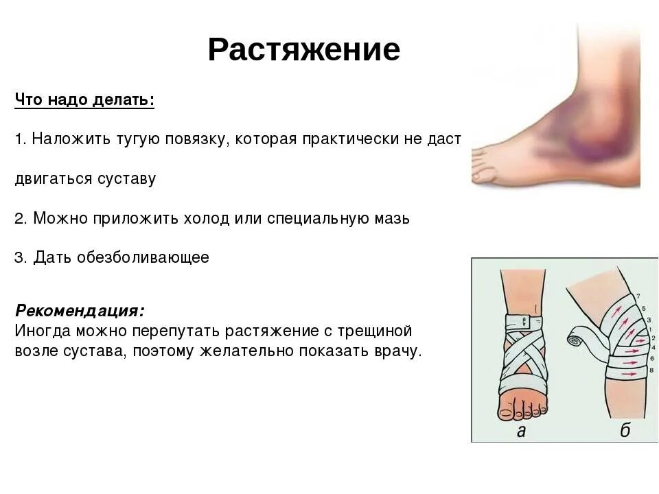 Растяжение голеностопа симптомы фото Внутреннее растяжение связок