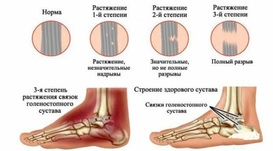 Растяжение голеностопного сустава симптомы фото Что происходит при растяжении связок