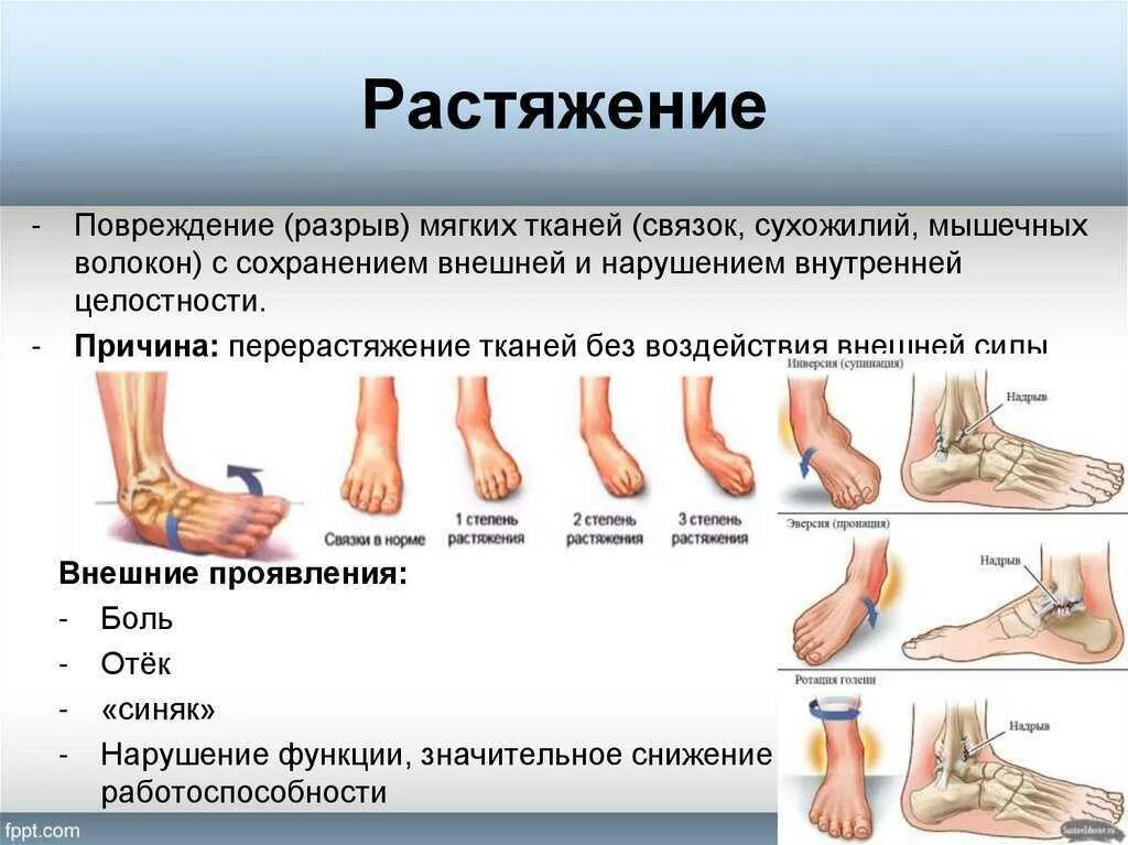 Растяжение симптомы фото Что у тебя нога есть: найдено 84 изображений