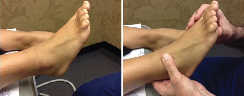 Растяжение симптомы фото Ankle sprain recovery protocol, ankle sprain protocol