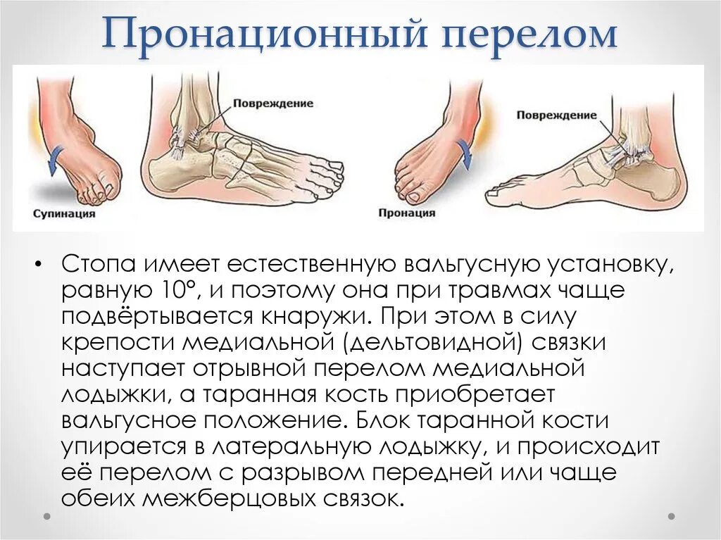 Растяжение стопы симптомы фото Картинки ПЕРВАЯ ПОМОЩЬ ПРИ РАСТЯЖЕНИИ ГОЛЕНОСТОПНОГО СУСТАВА