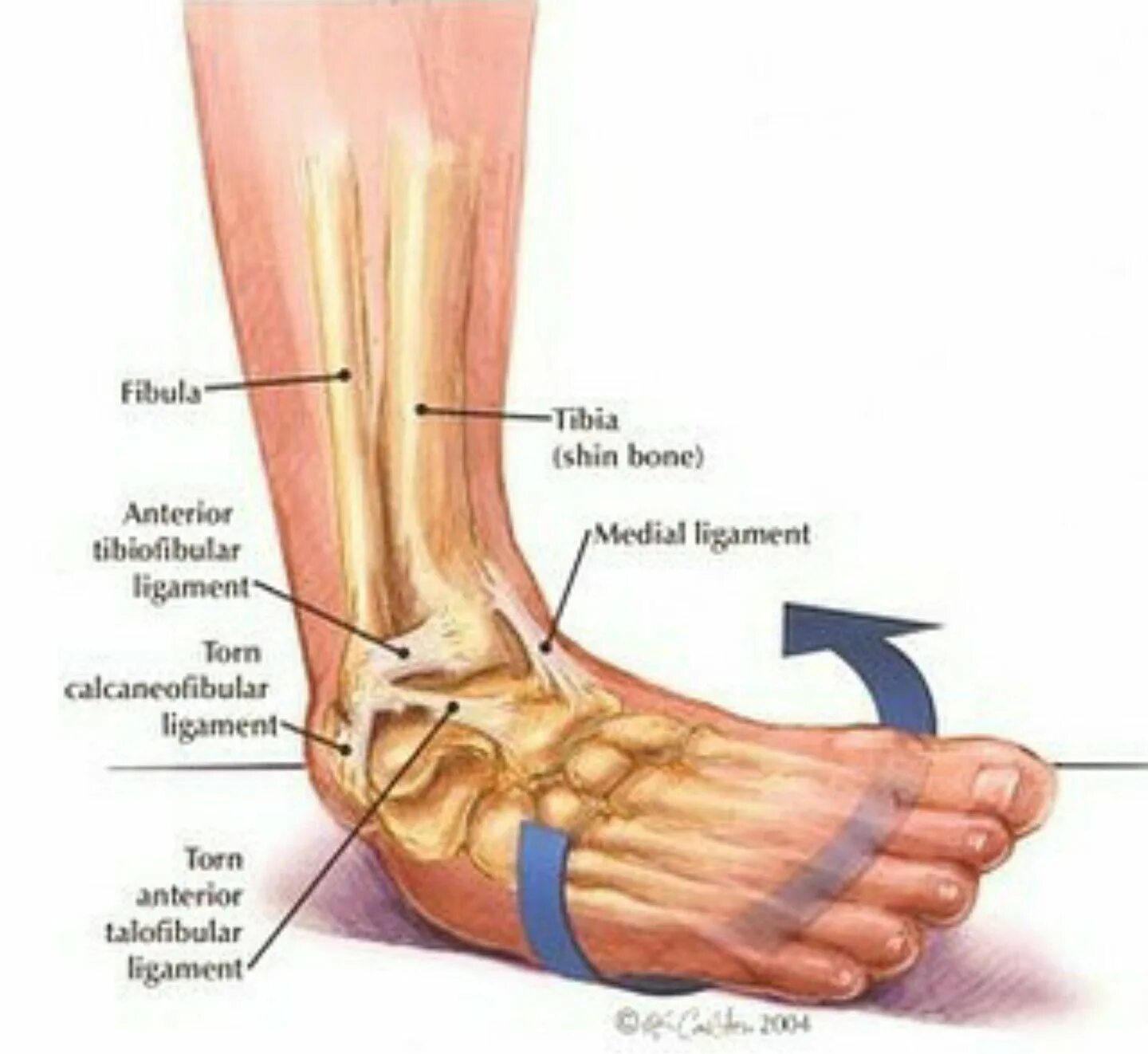 Растяжение стопы симптомы фото @doctor.macc Ankle sprain Ankle ligaments, Sprained ankle, Ankle anatomy