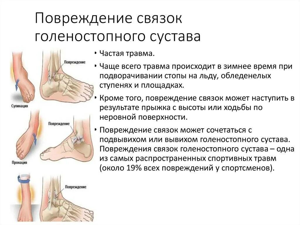 Растяжение стопы симптомы фото Растяжение связок голеностопного сустава, лечение в домашних условиях