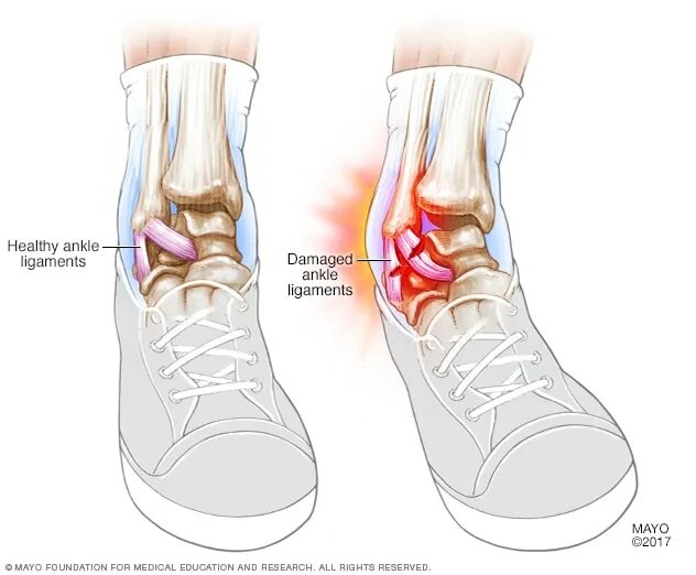 Растяжение стопы симптомы и лечение фото Sprains - Symptoms and causes - Mayo Clinic