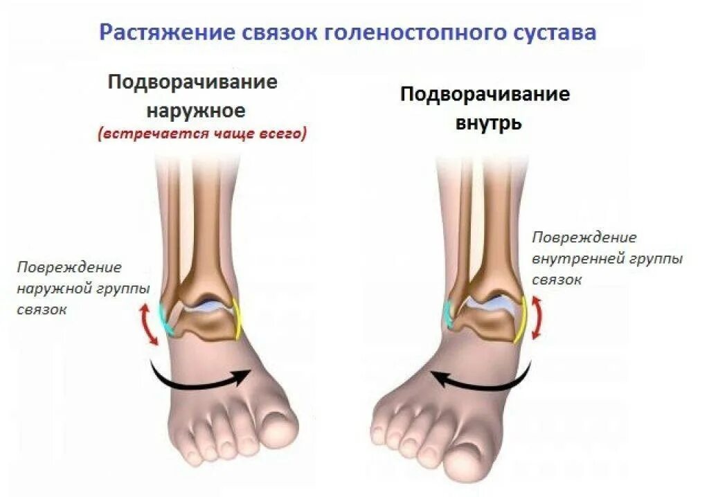 Растяжение стопы симптомы и лечение фото Внутреннее растяжение связок