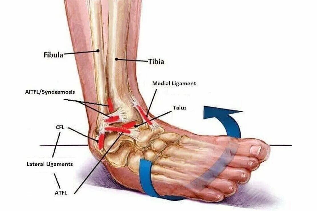 Растяжение связки голеностопа фото симптомы Chronic Ankle Instability Foot & Ankle Specialty Group, ankle stability