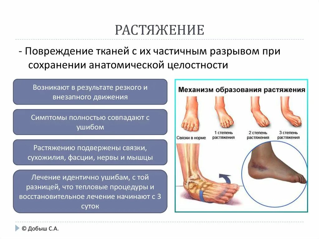 Растяжение связок голеностопного сустава симптомы фото Картинки ПРИЗНАКИ РАСТЯЖЕНИЯ СВЯЗОК ГОЛЕНОСТОПНОГО