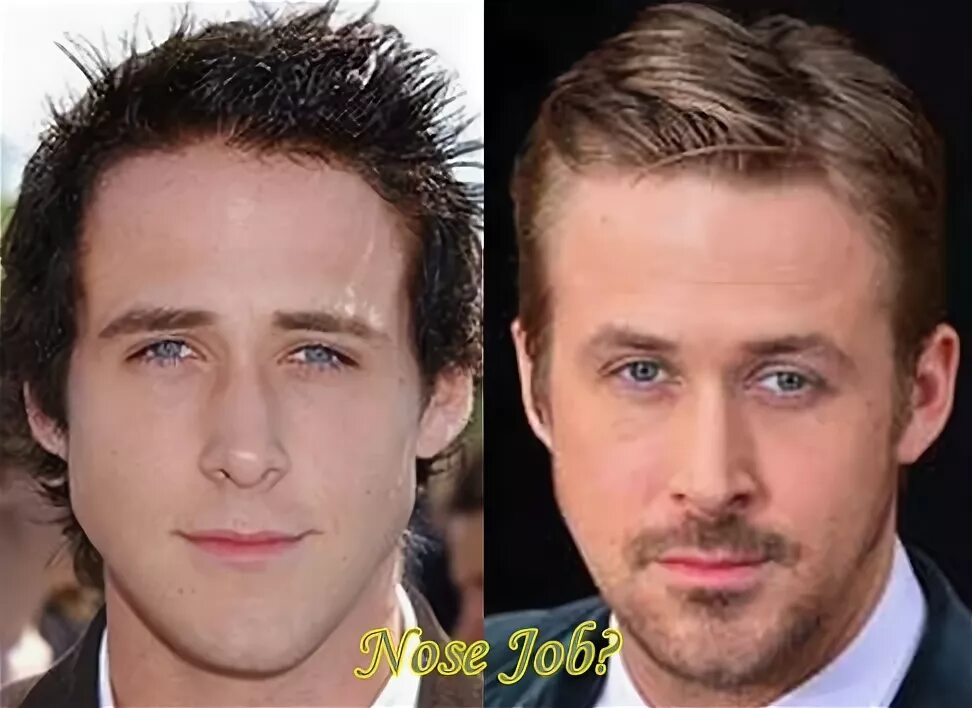 Райан гослинг фото до и после пластики Ryan Gosling Plastic Surgery Before and After - Latest Plastic Surgery Gossip An