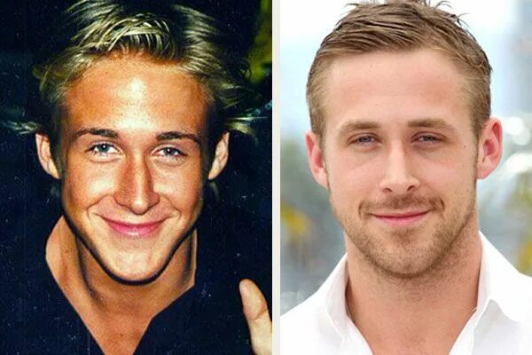 Райан гослинг фото до и после пластики ryan gosling pictures in 2019 Nose surgery, Surgery, Celebrity plastic surgery