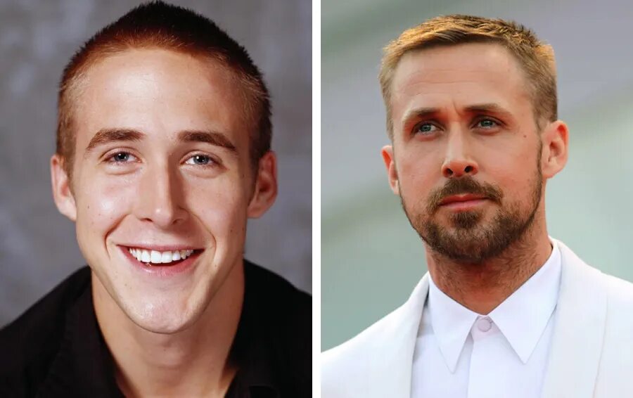 Ryan Gosling Nose Job Before & After surgerybeforeafter.com