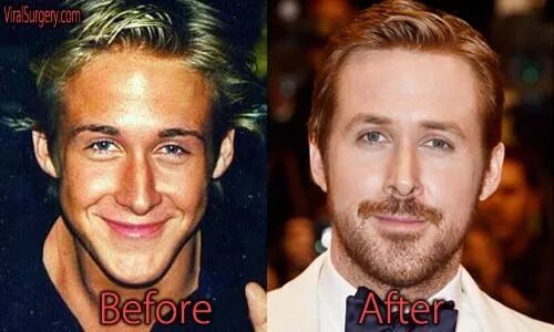 Райан гослинг фото до и после пластики Ryan Gosling Plastic Surgery, Before and After #ryangosling #nosejob #nosesurger