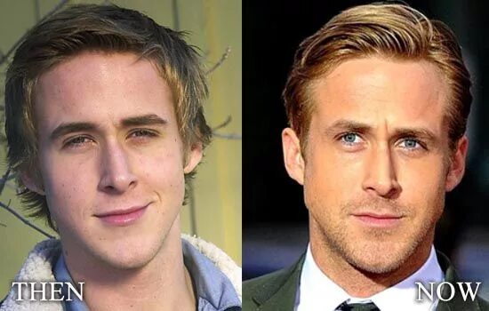 Райан гослинг фото до и после пластики Ryan Gosling Nose Job Rhinoplasty Before and After Picture