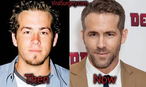 Райан рейнольдс фото до и после пластики Ryan Reynolds Plastic Surgery: Before and After Botox Pictures