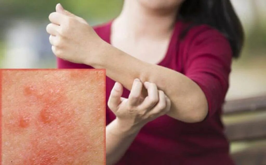 Eczema: Who is Affected and What You Need to Know Sanova Dermatology