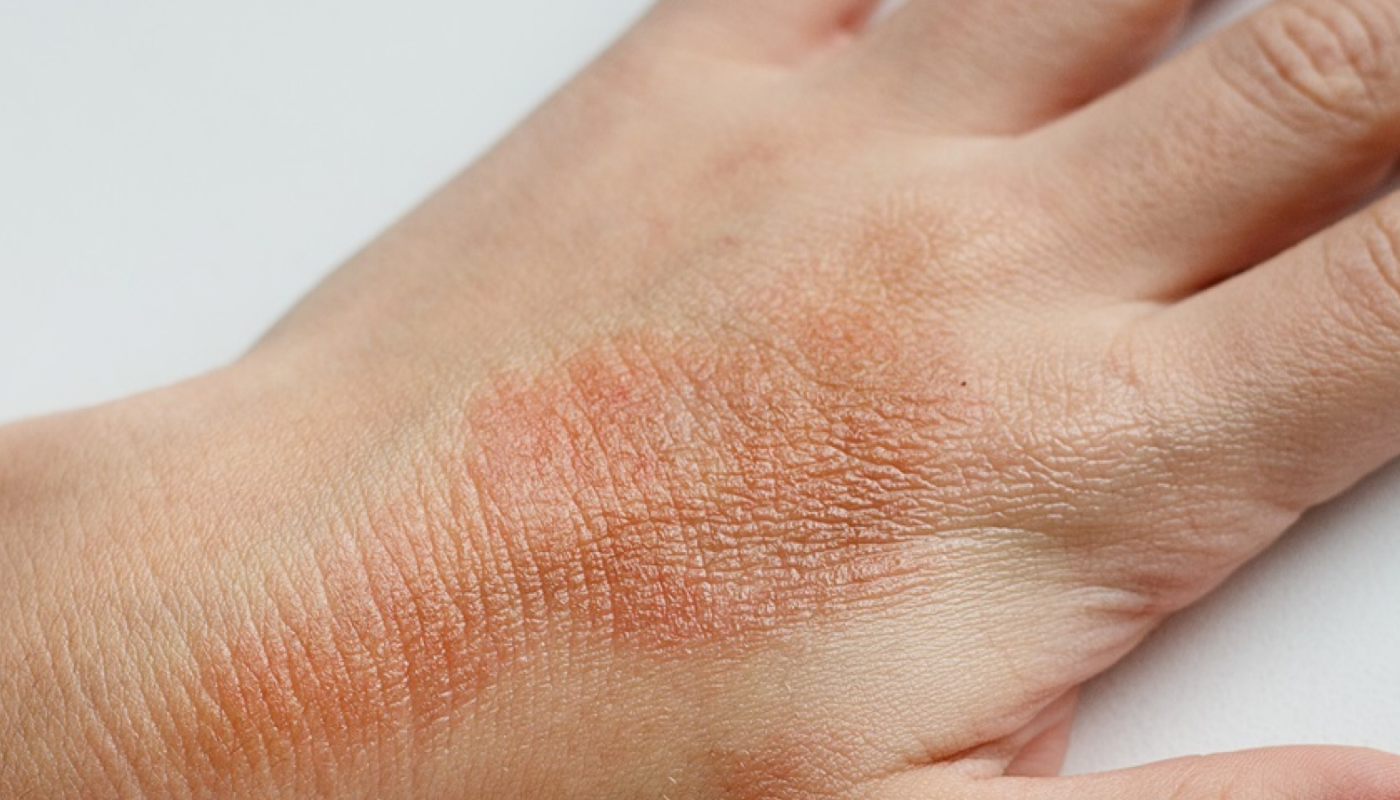 Eczema: Who is Affected and What You Need to Know Sanova Dermatology