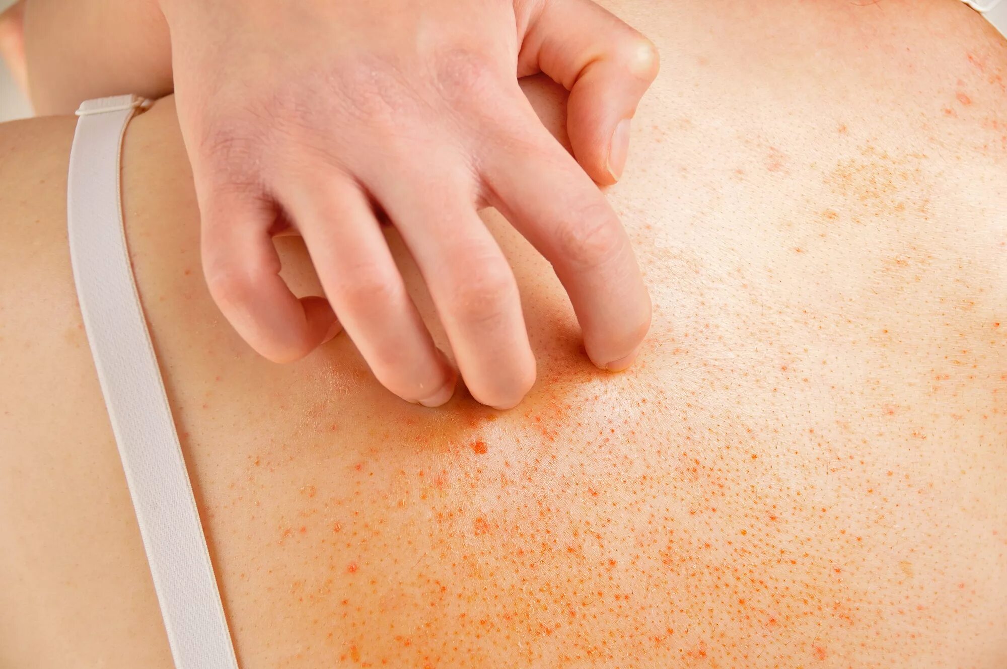 Eczema: Who is Affected and What You Need to Know Sanova Dermatology