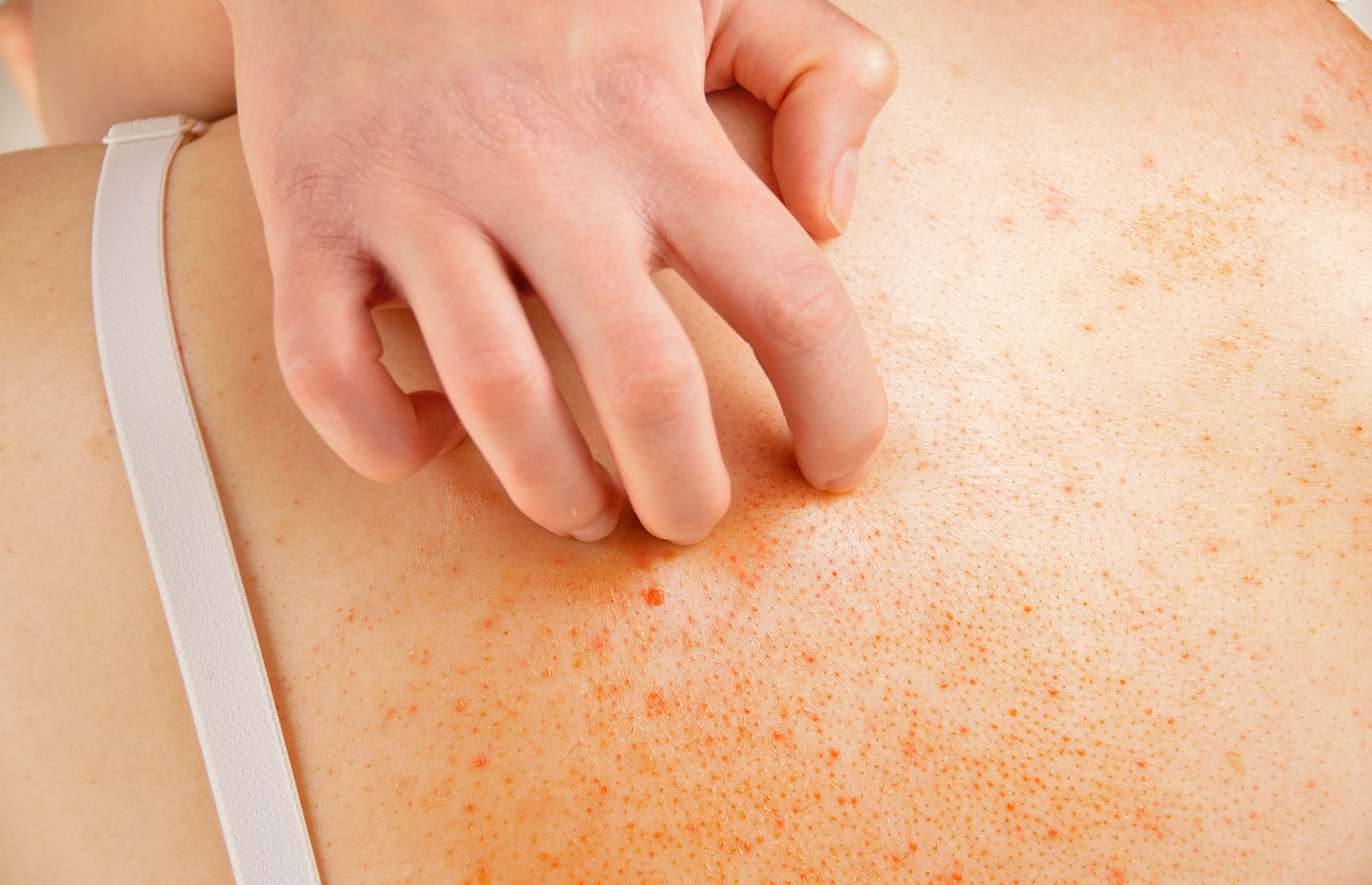 Eczema: Who is Affected and What You Need to Know Sanova Dermatology