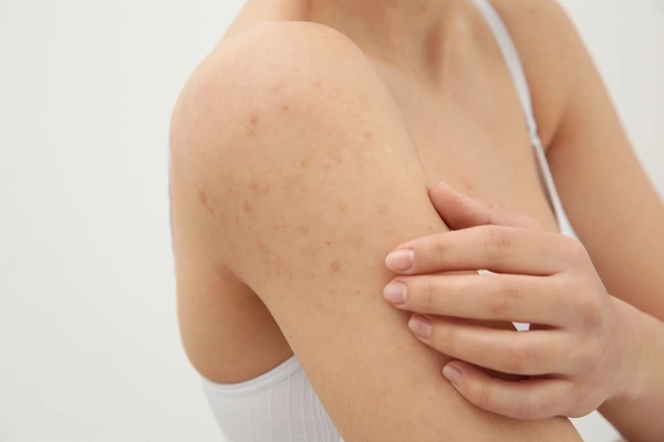 Eczema: Who is Affected and What You Need to Know Sanova Dermatology