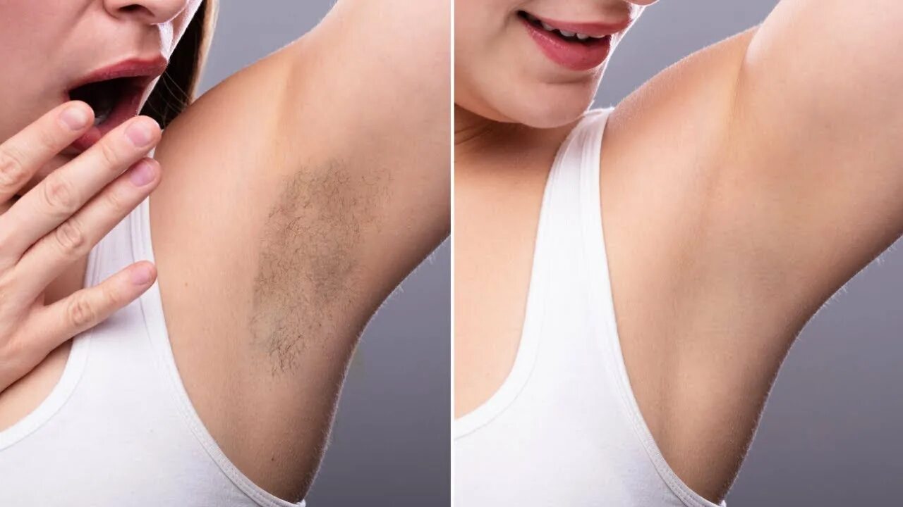 Раздражительный дерматит подмышек фото Under Arm Whitening Remove Your Underarm Dark in 5 Minute - YouTube