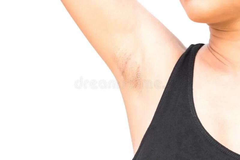 Раздражительный дерматит подмышек фото Women Problem Black Armpit on White Background for Skin Care and Stock Image - I