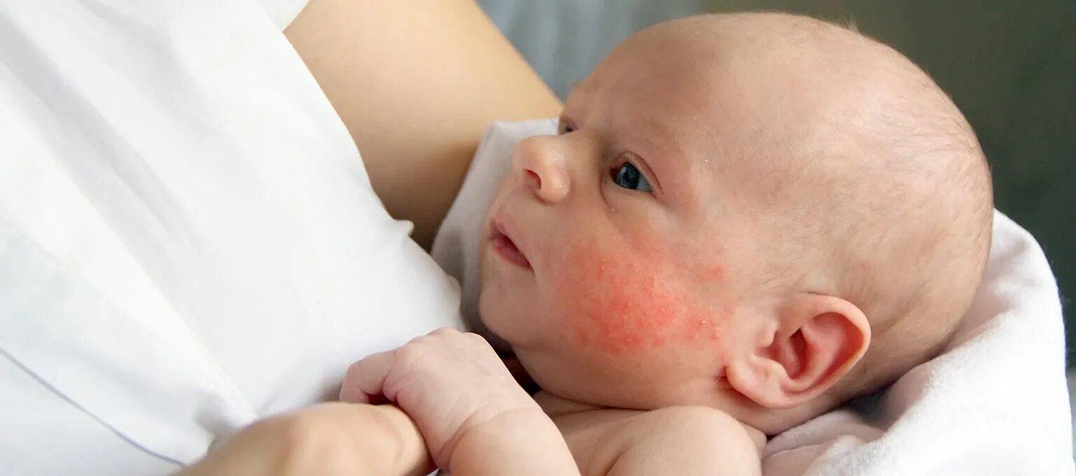 Раздражительный дерматит у грудничка фото 14 Types of Common Baby Rashes Pampers