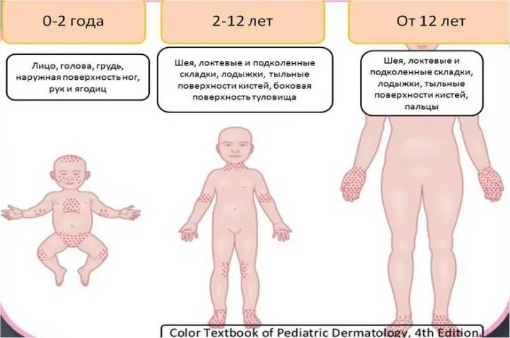 Раздражительный дерматит у ребенка как выглядит фото Изменения иммунитета при атопическом дерматите - Estet-Portal