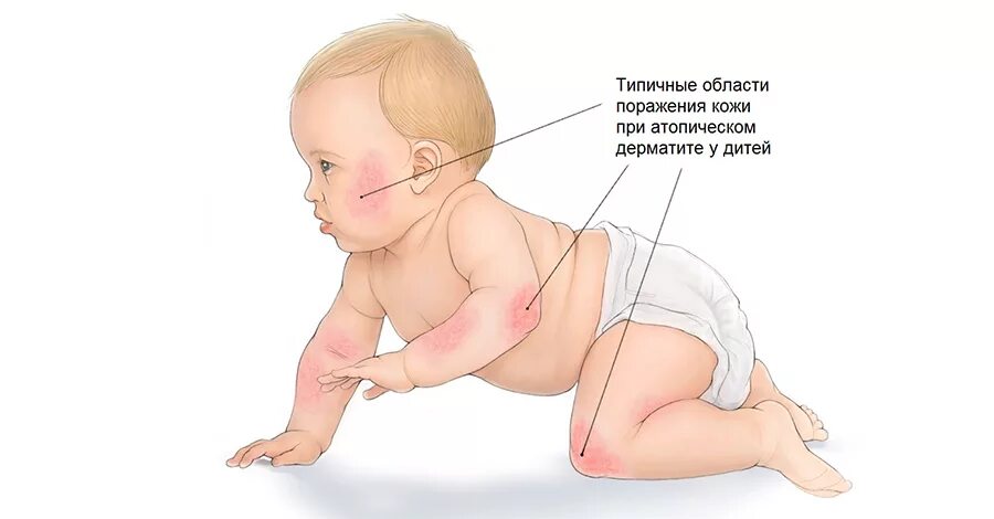 Раздражительный дерматит у ребенка как выглядит фото Дерматит у детей: виды, симптомы, лечение