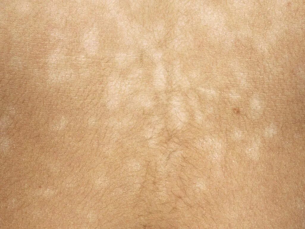 Tinea versicolor - Wikipedia