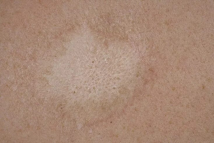 Tinea versicolor - Wikipedia