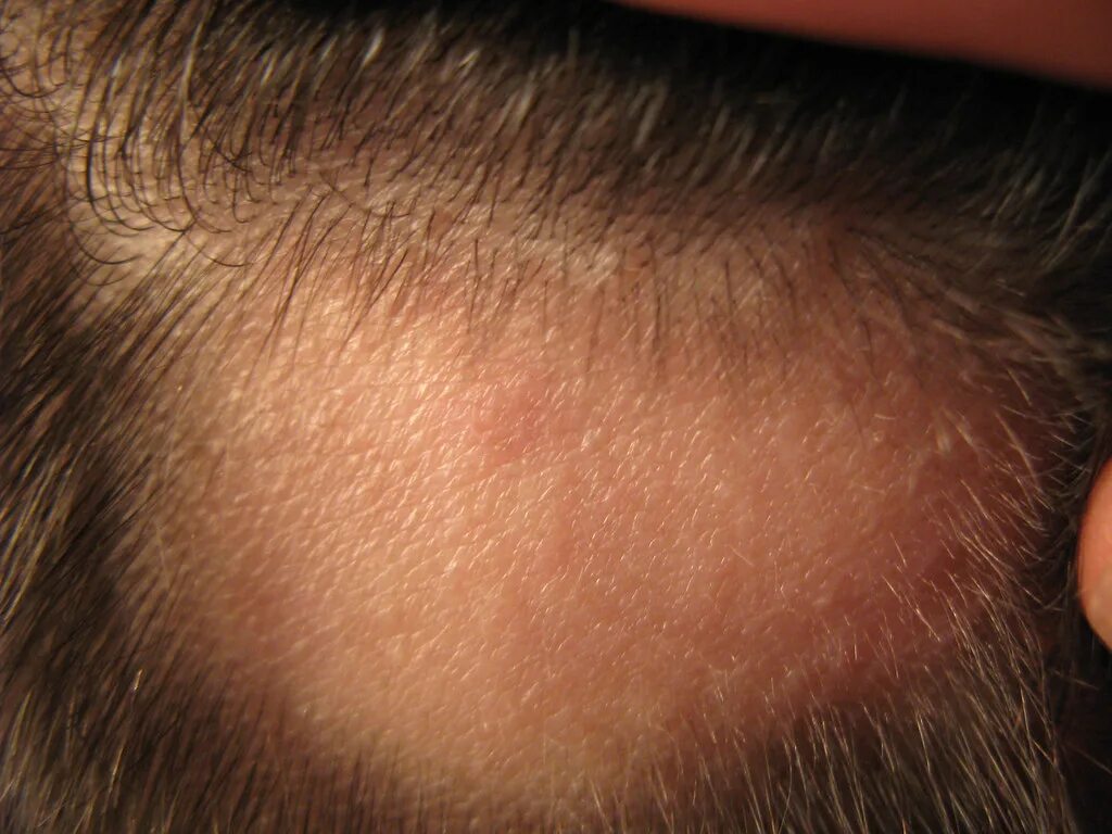 Разноцветный лишай на голове фото alopecia grow back The bald spot on the back of my head se. Flickr