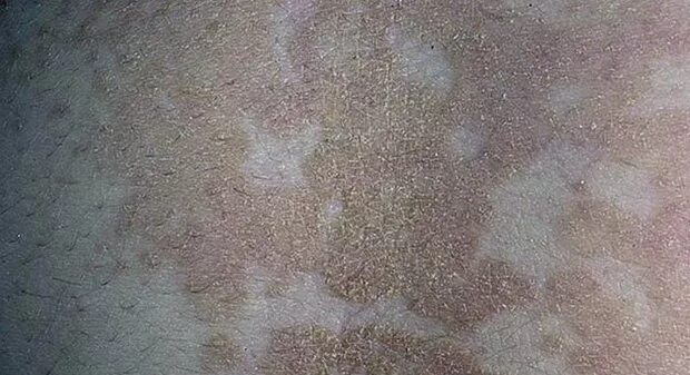 Tinea versicolor - Wikipedia