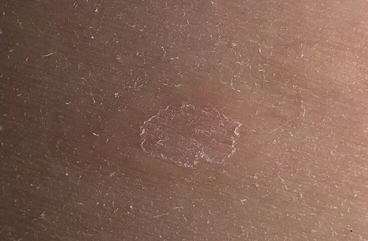 Tinea versicolor - Wikipedia