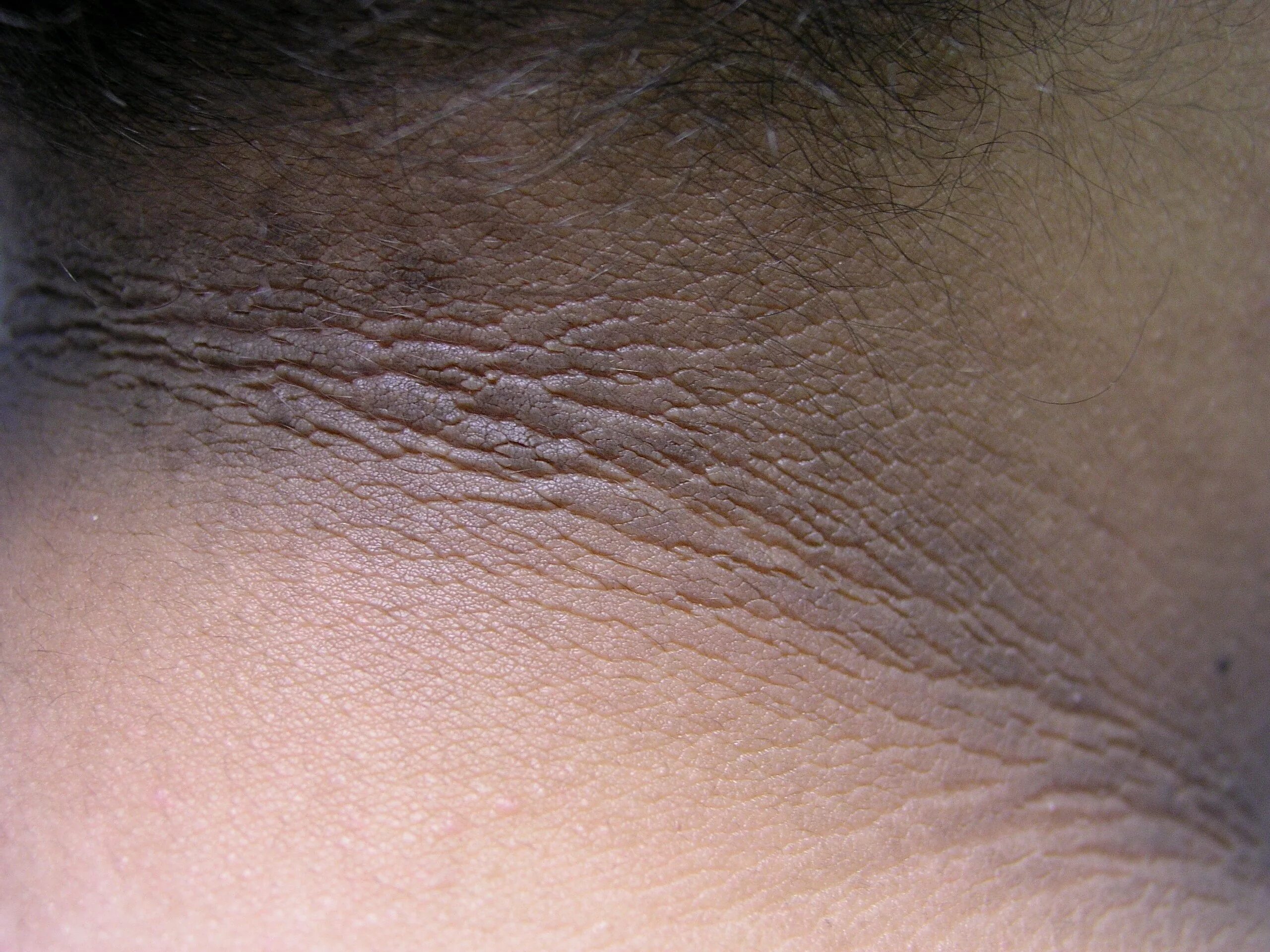 Разноцветный лишай в паху у женщин фото Acanthosis nigricans - Cancer Therapy Advisor