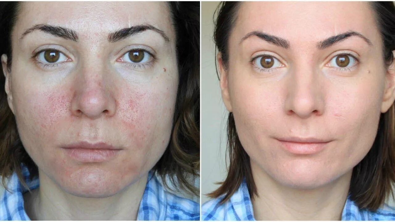 Разновидность дерматита на лице фото Face Rash Swelling: Causes, Treatment, and When to See a Doctor