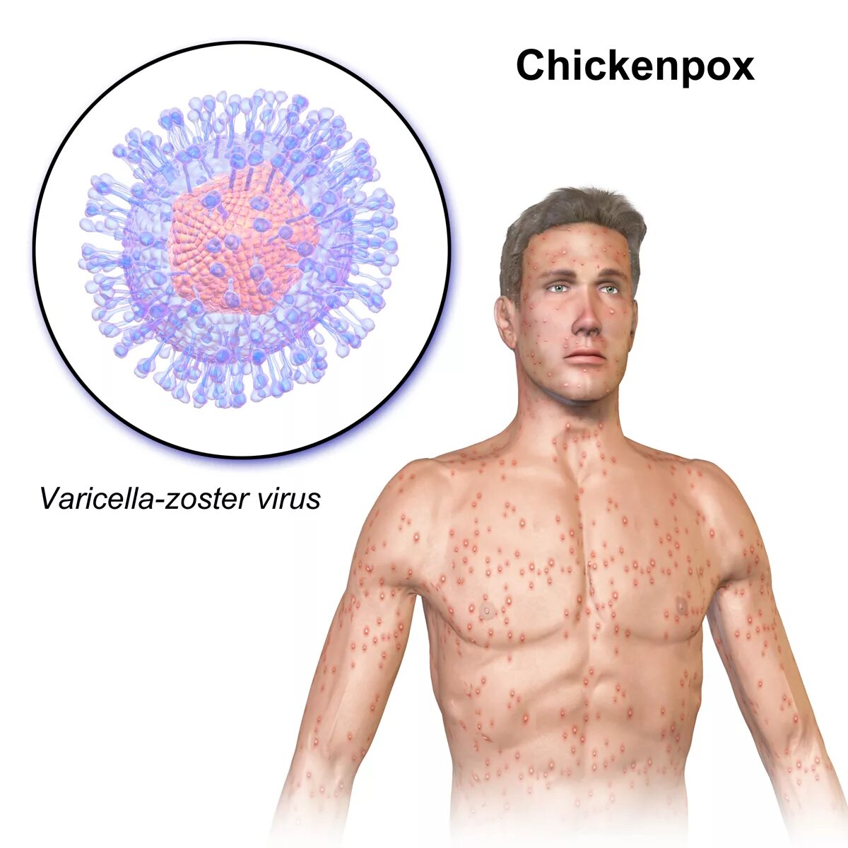 Разновидности герпеса на теле фото File:Chickenpox.png - Wikipedia